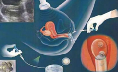 揭秘桃花借卵宝宝，性别之谜